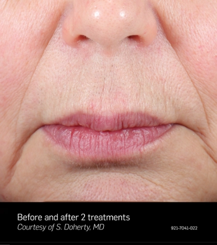 EliteiQ BA 3 HR USA-EN laser hair removal_After